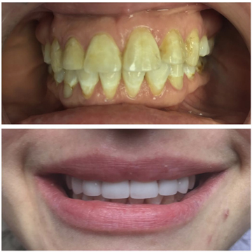 Smile Gallery - Before and After Image