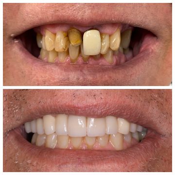 Smile Gallery - Before and After Image