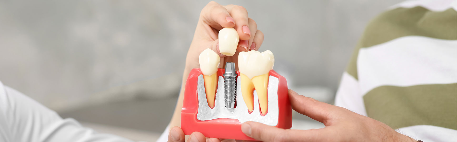 Bone Graft for Dental Implant: Purpose and Procedure
