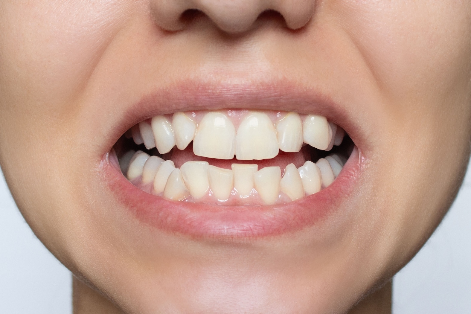 A close-up image of a woman's smile with crooked teeth.