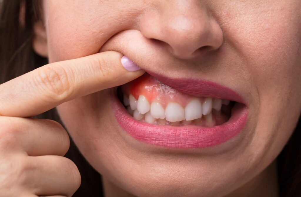 Close-up of a person lifting their upper lip to reveal swollen gums.